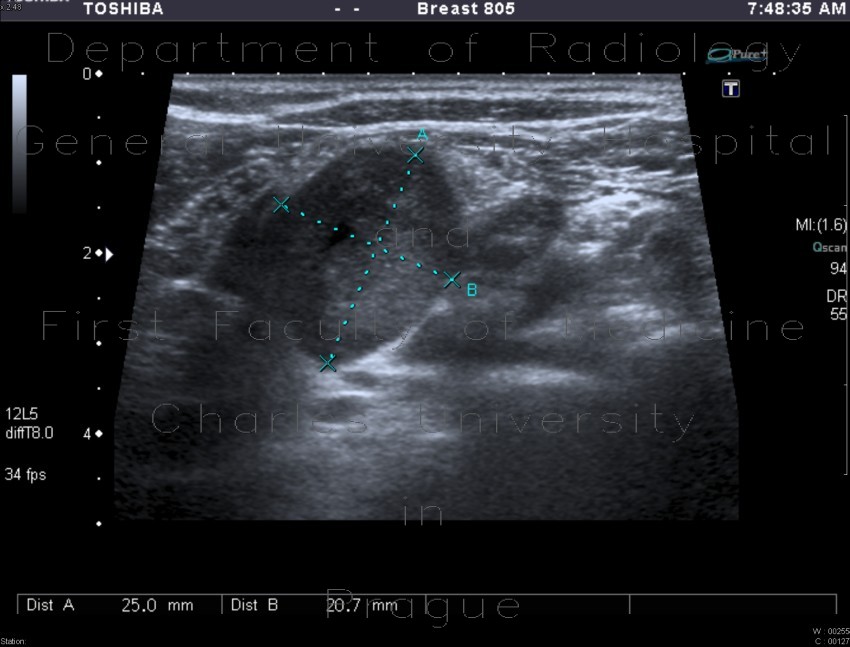 Tumorous infiltration of lymph node
