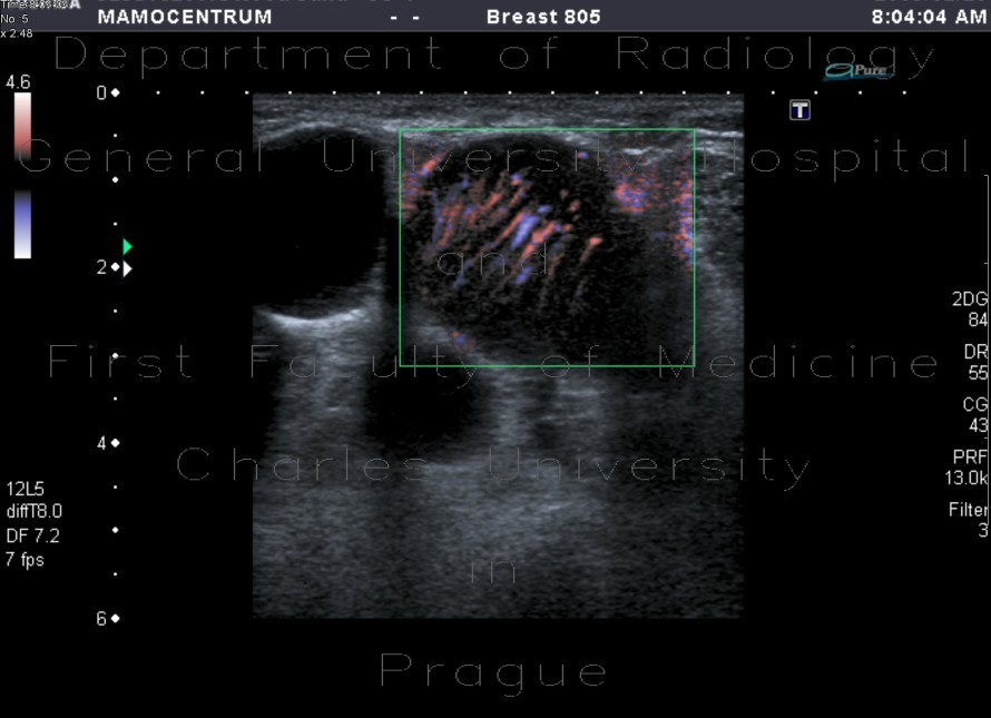 Radiology image - Tumorous infiltration of lymph nodes: Thorax, Lymphatic: US - Ultrasound