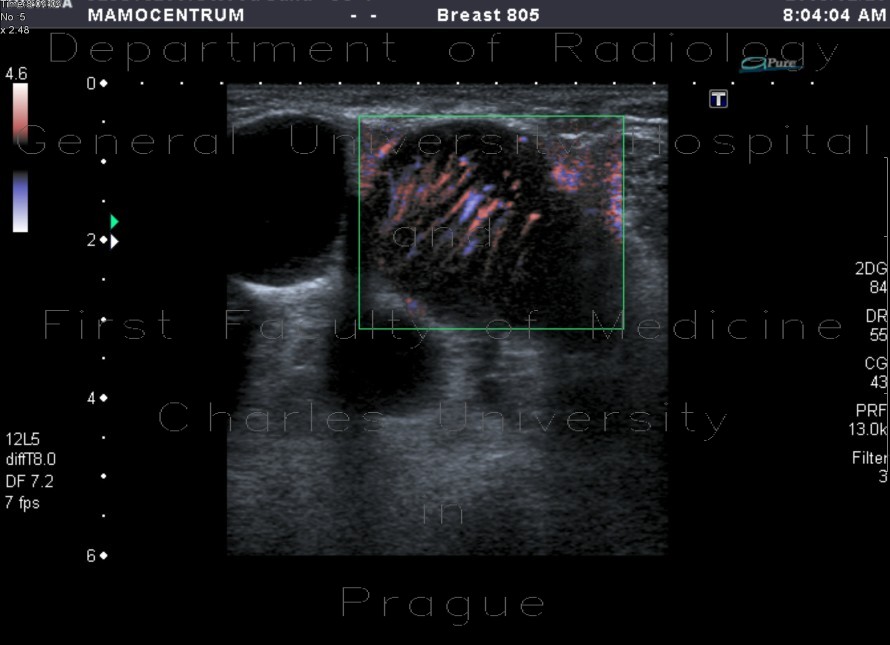 Tumorous infiltration of lymph nodes