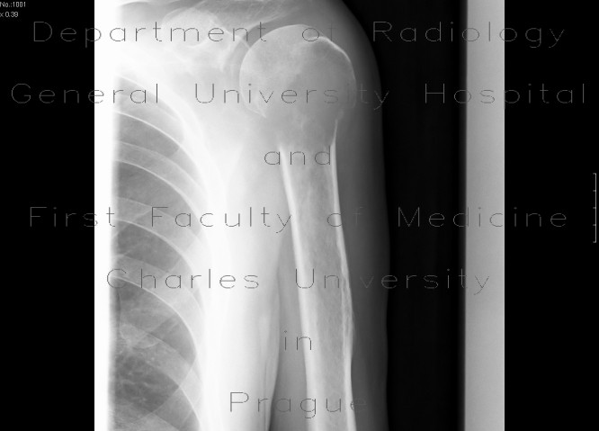 cortex of bone. one, thinning of cortex.