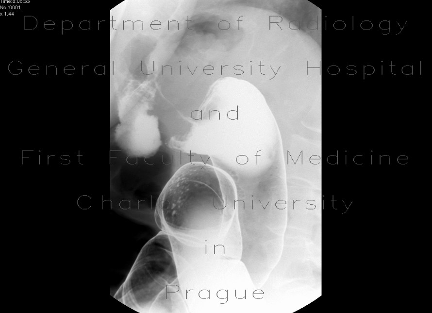 Radiology image - Tumorous stenosis of lienal flexure, severe stenosis, barium enema: Abdomen, Large bowel: RF - Fluoroscopy