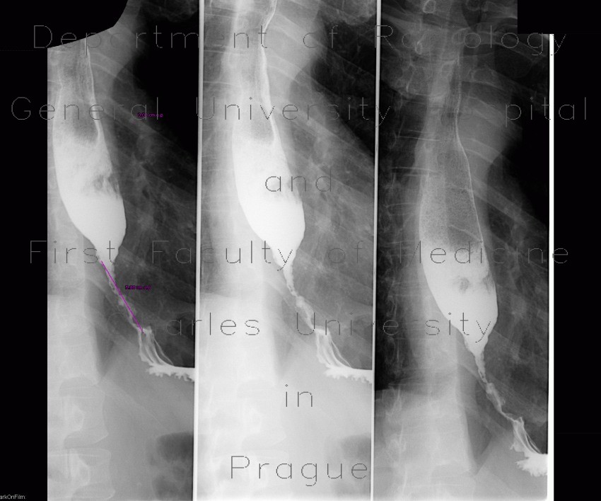 Tumorous stenosis of oesophagus