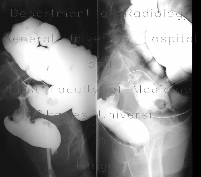 Radiology image - Tumorous stenosis of rectosigmoid junction, polyp of sigmoid colon, irrigography: Abdomen, Large bowel: RF - Fluoroscopy