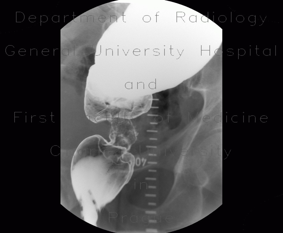 Radiology image - Tumorous stenosis of rectum and sigmoid colon, duplicity, DCBE: Abdomen, Large bowel: RF - Fluoroscopy
