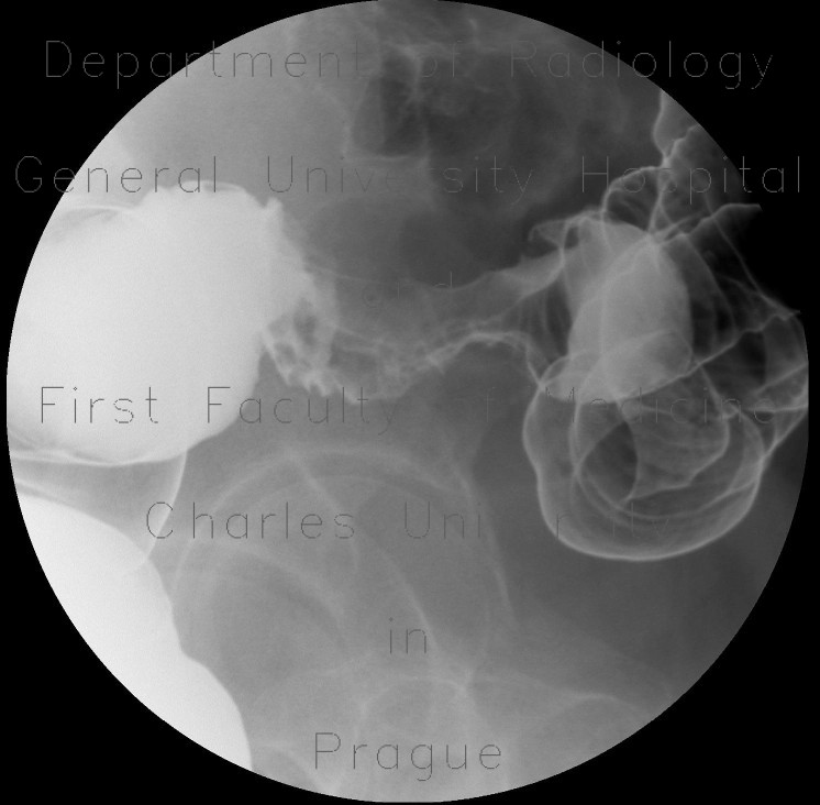 Radiology image - Tumorous stenosis of the sigmoid colon: Abdomen, Large bowel: RF - Fluoroscopy