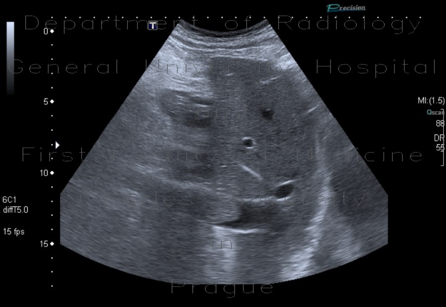 Tumorous thrombosis of inferior vena cava, adrenal metastasis, conventional renal carcinoma