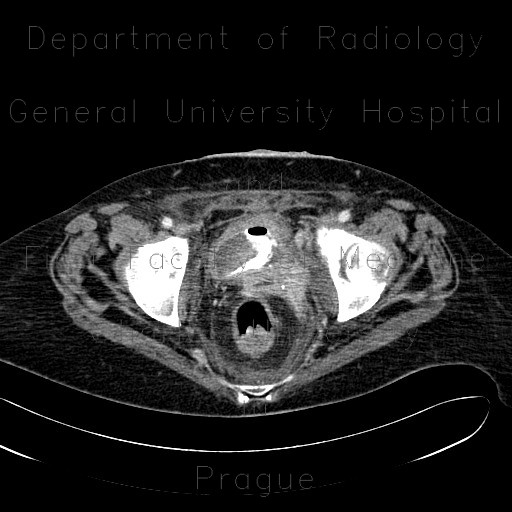 Tumour and fistula of the urinary bladder, fistula of small bowel