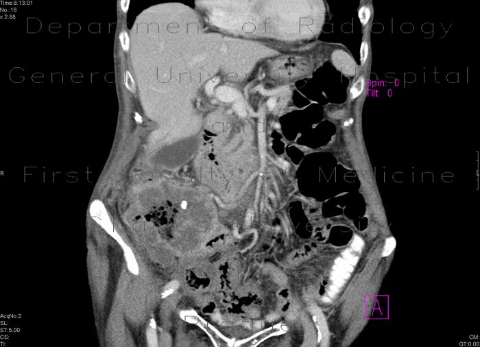 Tumour of cecum