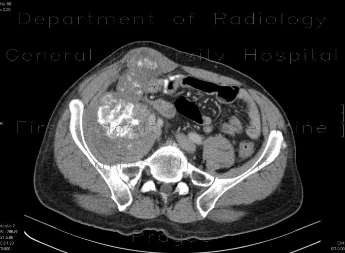 Tumour of cecum, extensive