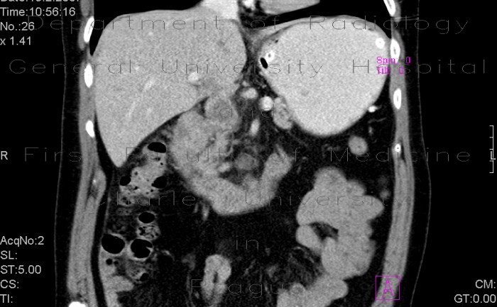 Radiology image - Tumour of duodenum: Abdomen, Small bowel: CT - Computed tomography