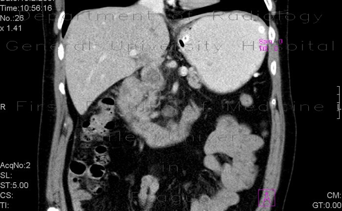 Tumour of duodenum