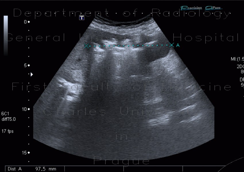 Tumour of large bowel on ultrasound