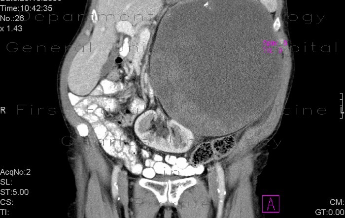 Radiology image - Tumour of pancreas, huge: Abdomen, Pancreas: CT - Computed tomography