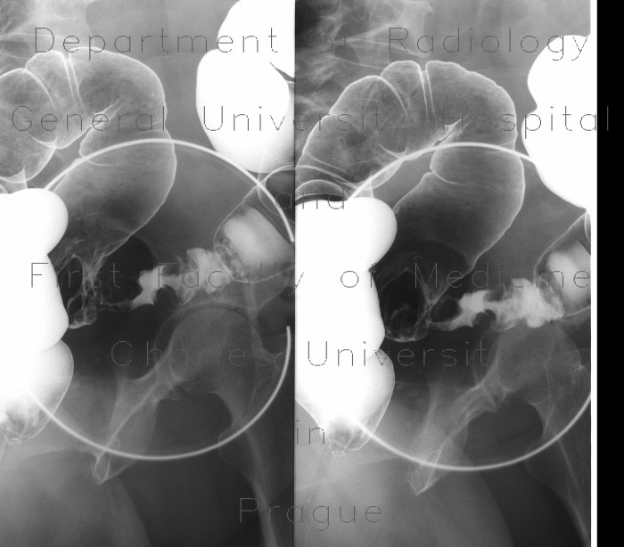 Tumour of sigmoid colon, irrigography