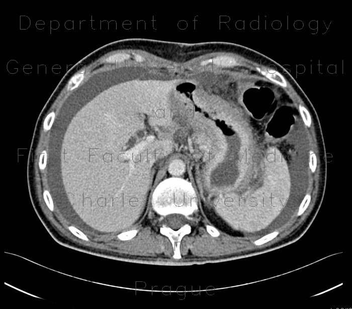 Tumour of stomach, ascites