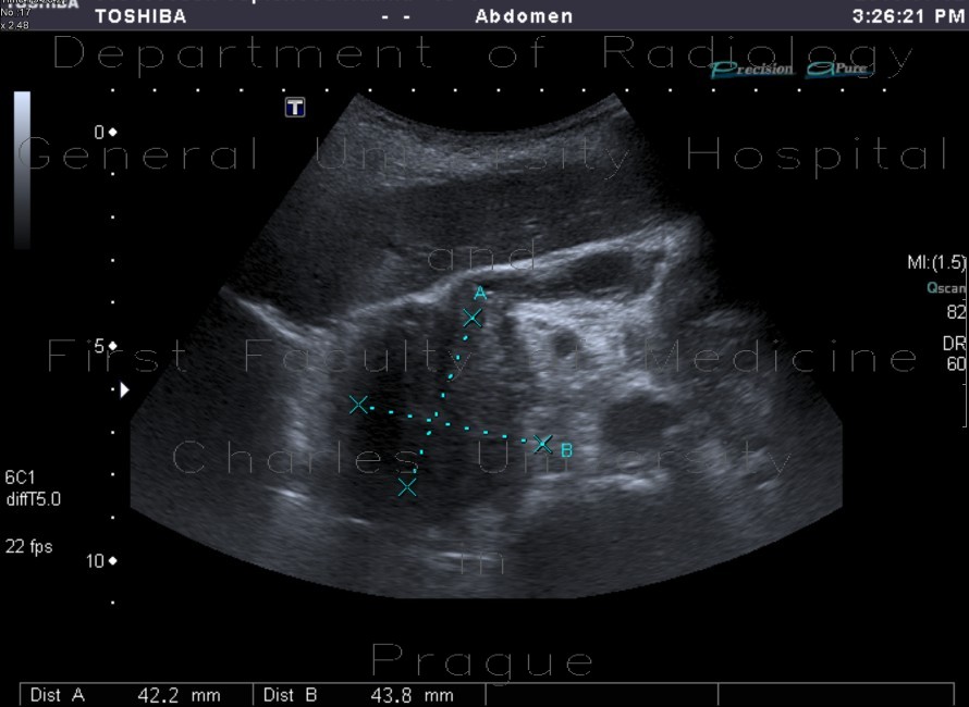 Radiology image - Tumour of the head of pancreas, dilated bile duct, biliary stent, dilated pancreatic duct, cholecystolithiasis, biliary stones: Abdomen, Biliary tree, Pancreas: US - Ultrasound