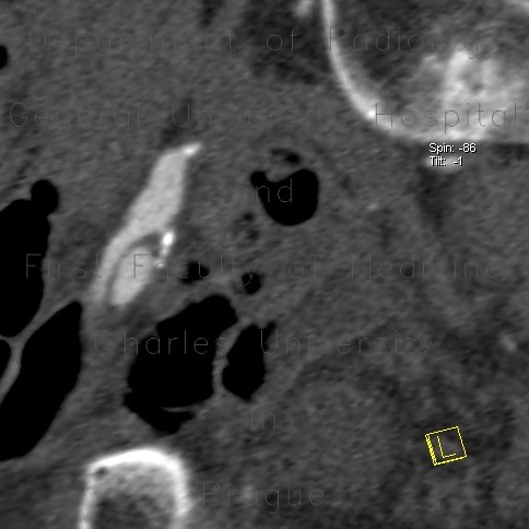 Ulcerated plaque of external iliac artery