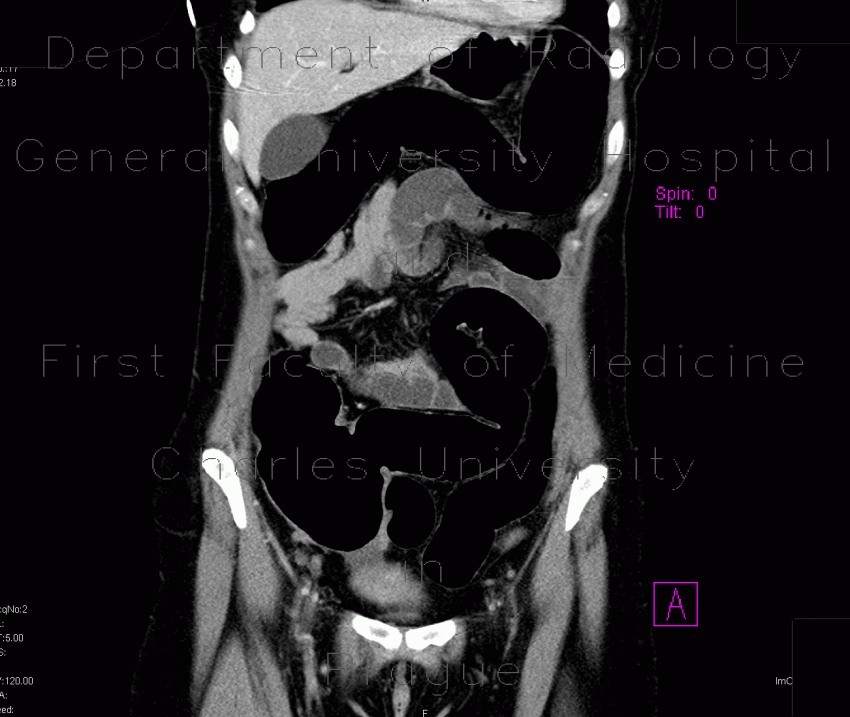 Ulcerative colitis, CT colonography