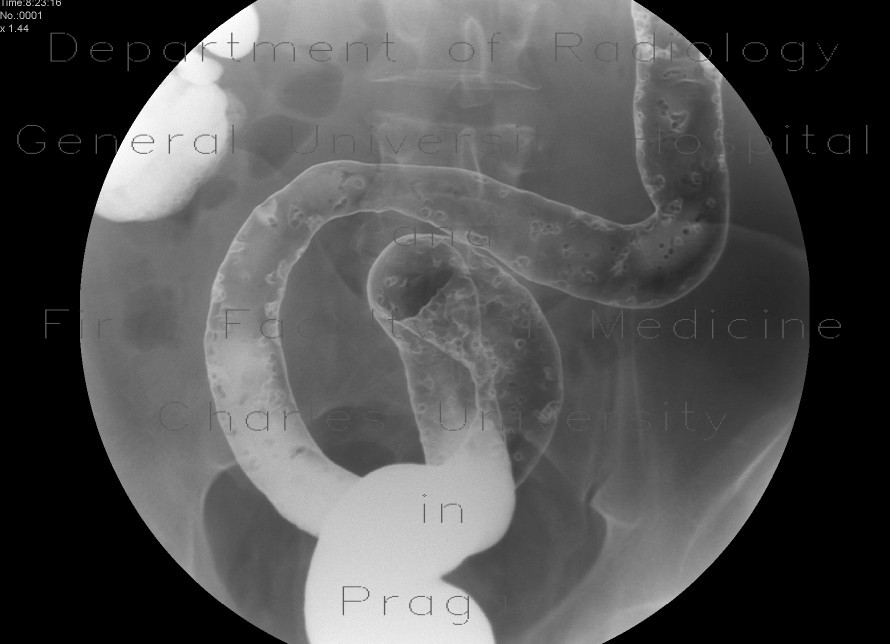 Ulcerative colitis, barium enema