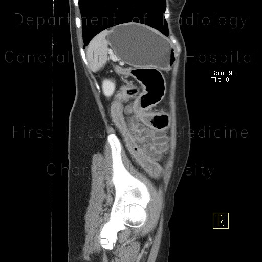 Ulcerative colitis, enterography