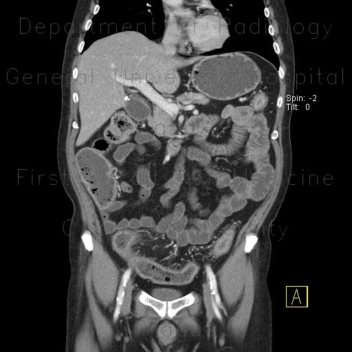 Radiology image - Ulcerative colitis, enterography: Abdomen, Large bowel: CT - Computed tomography