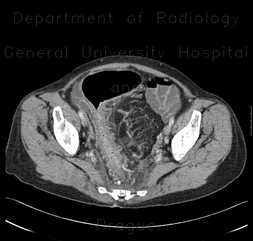 Ulcerative colitis of left colon, enterography