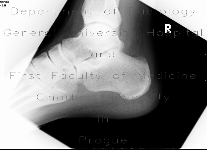Undisplaced fracture of calcaneus