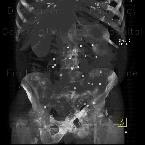 Radiology image - Unknown pathology, foreign bodies in peritoneal cavity: Abdomen, Peritoneal cavity: CT - Computed tomography