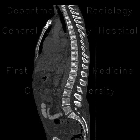 Unknown pathology of spine