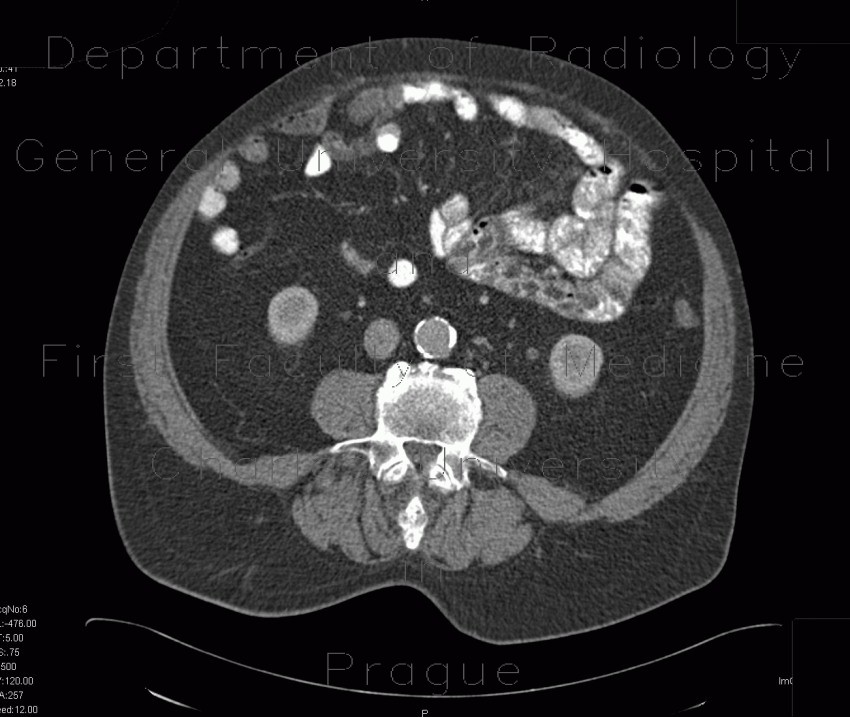 Radiology image - Unknown pathology, secondary finding, small bowel: Abdomen, Small bowel: CT - Computed tomography