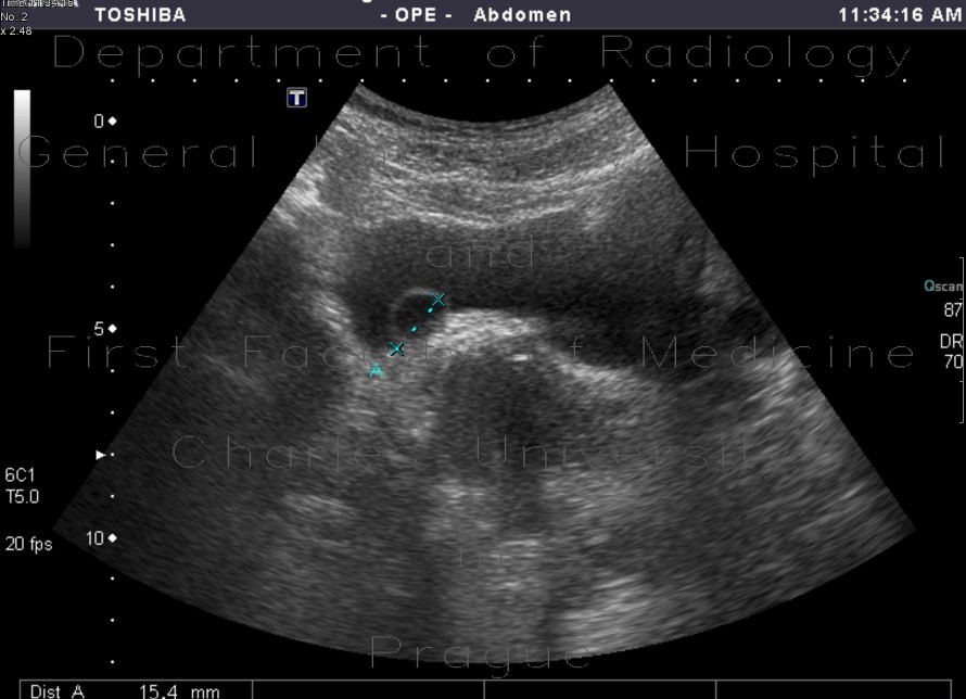 Radiology image - Ureterocoele: Abdomen, Urinary tract: US - Ultrasound