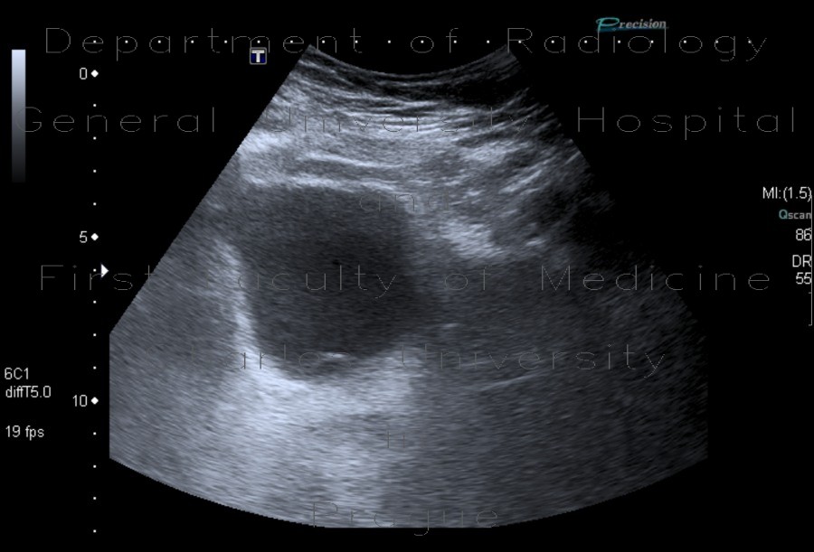 Radiology image - Ureterocoele, outpouching of ureter into bladder: Abdomen, Urinary tract: US - Ultrasound