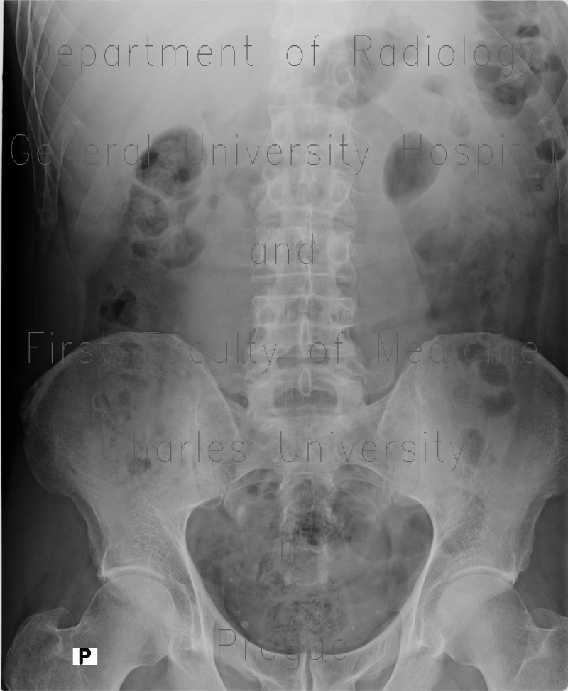 Radiology image - Ureterolithiasis, phleboliths: Abdomen, Urinary tract: X-ray - Plain radiograph