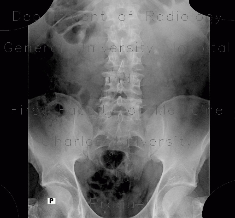 Radiology image - Ureterolithiasis, urolithiasis, hydronephrosis, grade II: Abdomen, Kidney and adrenals, Urinary tract: X-ray - Plain radiograph
