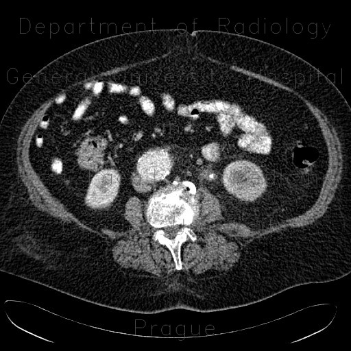 Radiology image - Uretherolithiasis in pyeloureteral junction, PUJ: Abdomen, Kidney and adrenals, Urinary tract: CT - Computed tomography