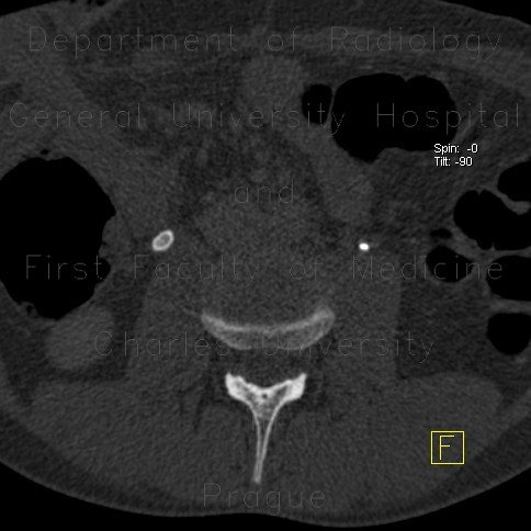 Uretherolithiasis, urolithiasis, ureteric stone, hydronephrosis, unenhanced