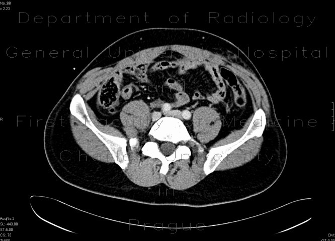 Urinoma