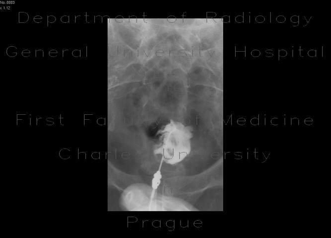 Urocystocutaneous fistula, fistulography