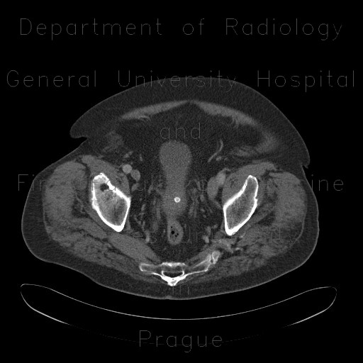 Urocystolithiasis, stone in urinary bladder