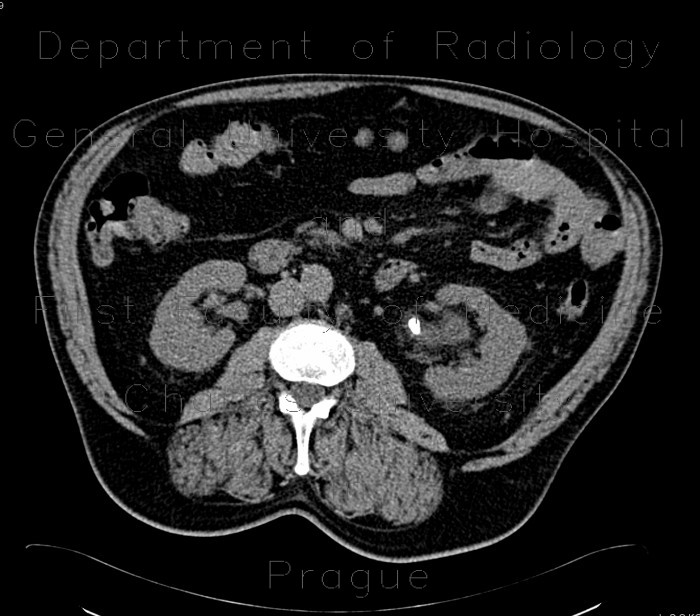 Urolithiasis in pelviureteric junction