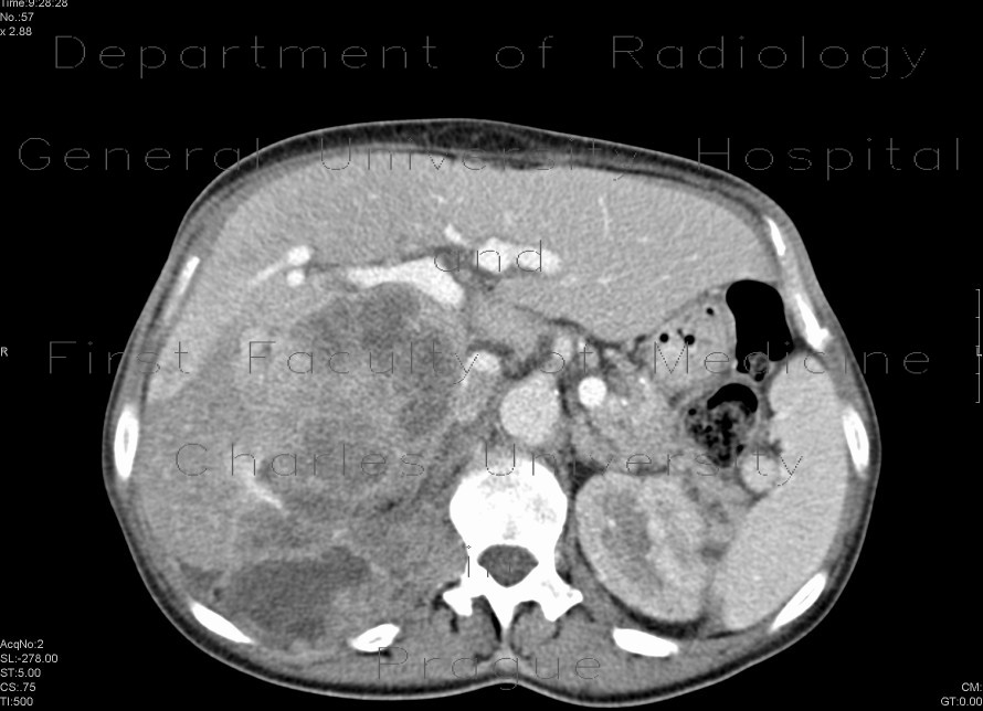 Radiology image - Urothelial carcinoma, gigantic: Abdomen, Kidney and adrenals, Retroperitoneum, pelvis: CT - Computed tomography