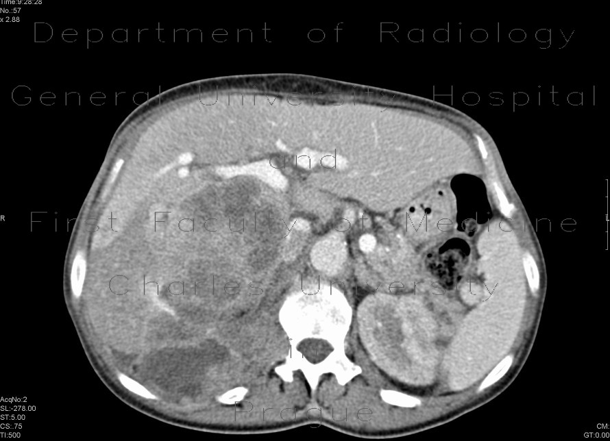 Urothelial carcinoma, gigantic