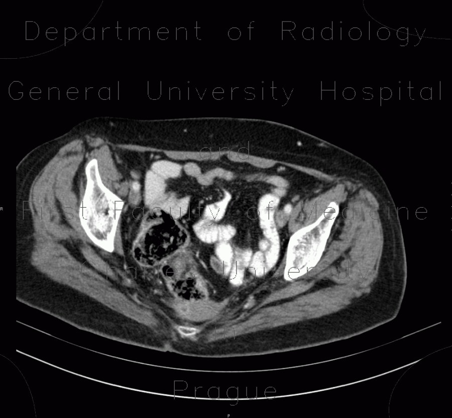 Radiology image - Uterus, mimics a presacrall mass, extirpation of anus: Abdomen, Gynecology: CT - Computed tomography