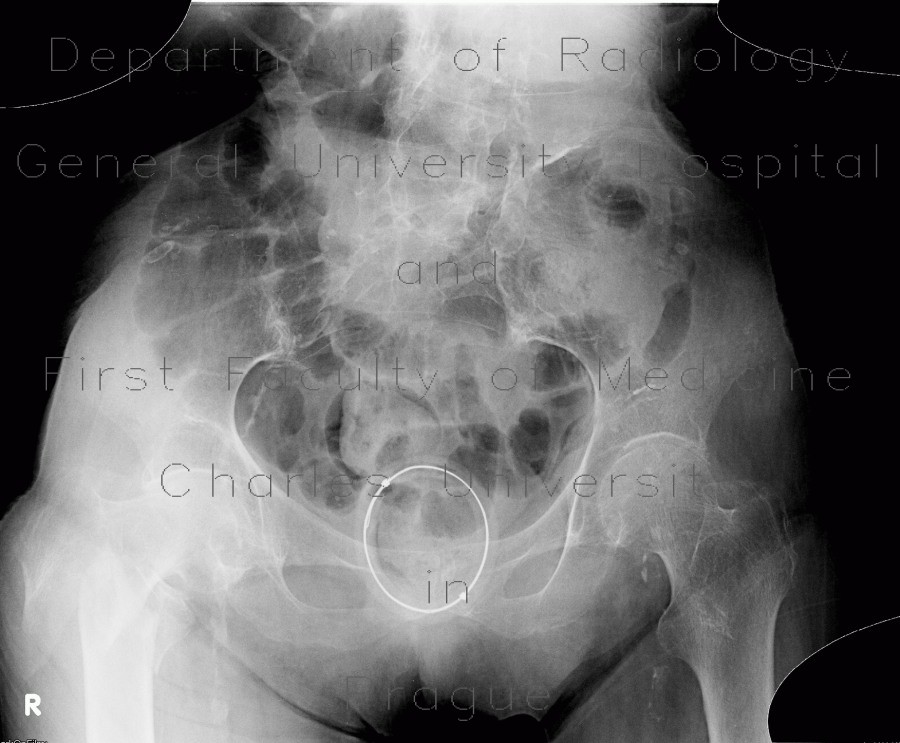 Vaginal pessary