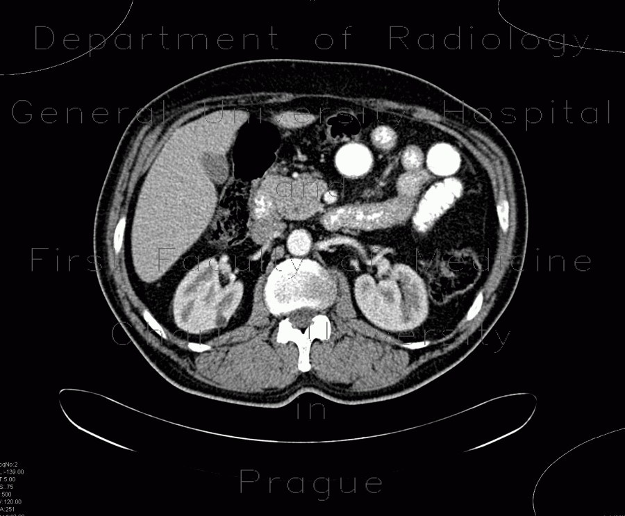 Variant of head of pancreas