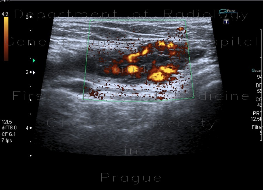 Varices in groin, inguinal canal