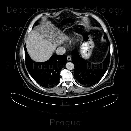 Radiology image - Varicose dilation of the biliary ducts in the left liver lobe, unknown origin: Abdomen, Biliary tree, Liver: CT - Computed tomography