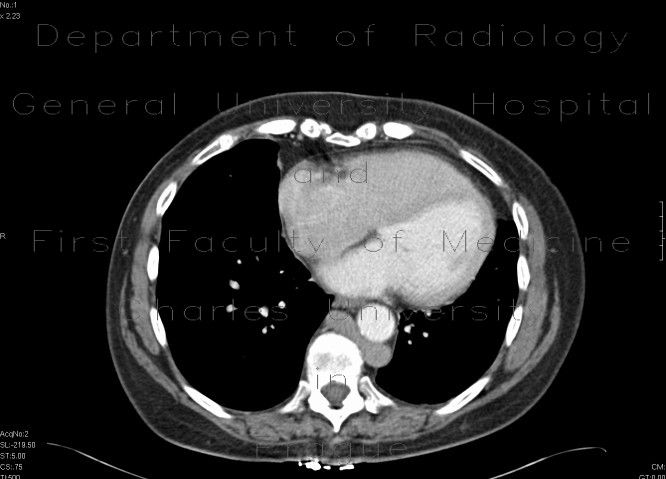 Vena cava sinistra, continuation of hemiazygous vein