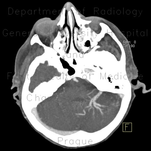 Venous angioma, cerebellum