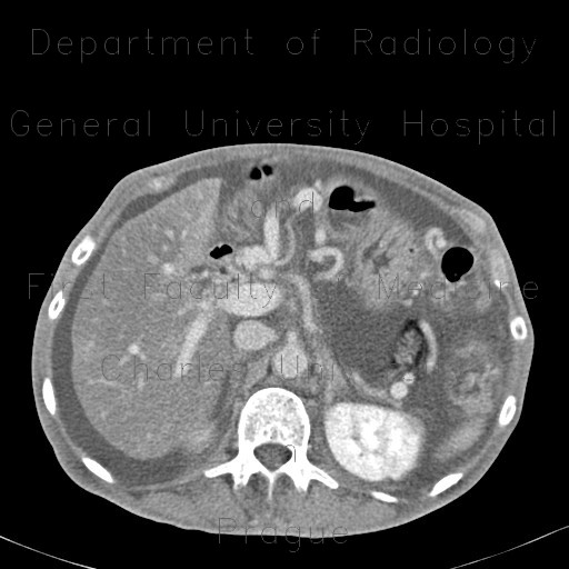 Radiology image - Venous congestion, thrombosis of superior mesenteric vein, ascites, steatosis of liver: Abdomen, Large bowel, Liver, Small bowel, Vessels: CT - Computed tomography
